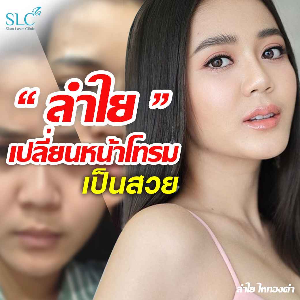 ฉีดปาก_ฟิลเลอร์ปาก_Filler Lip_ลำไย ไหทองคำ