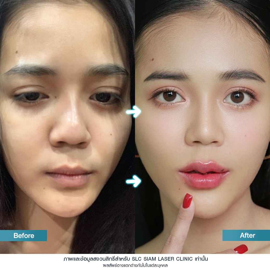 ฉีดปาก_ฟิลเลอร์_Filler Lip_ลำไย ไหทองคำ_ฉีดสารเติมเต็ม_ฉีดขมับ_ฉีดร่องแก้ม