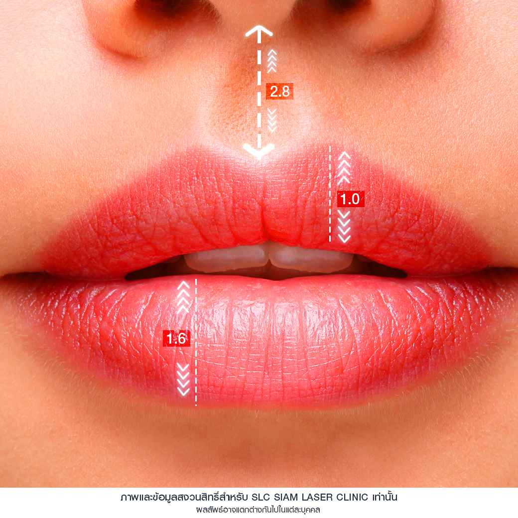 Filler_lip filler_Filler injection_lip injection