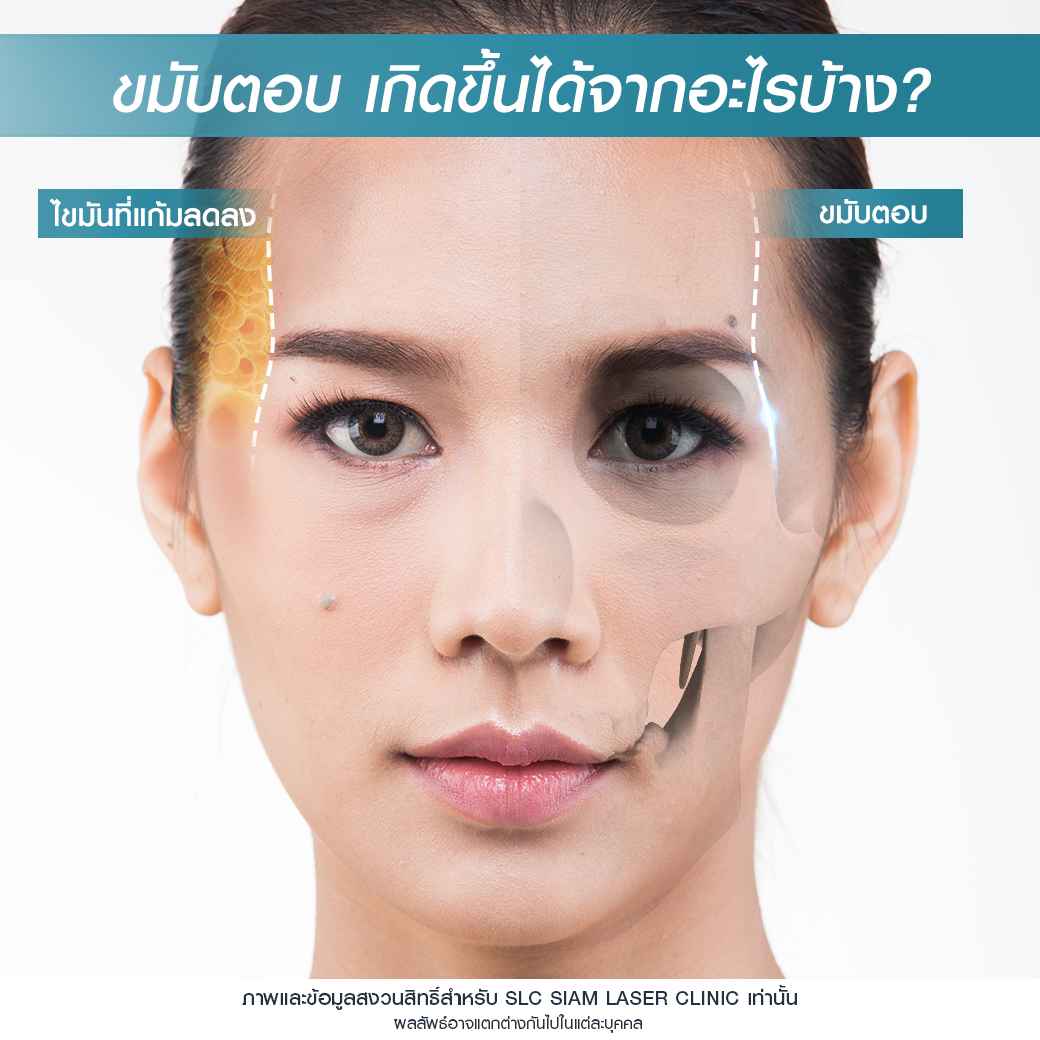 ฉีดปาก_ฟิลเลอร์_Filler Lip_ลำไย ไหทองคำ_ฉีดสารเติมเต็ม_ฉีดขมับ_ฉีดร่องแก้ม