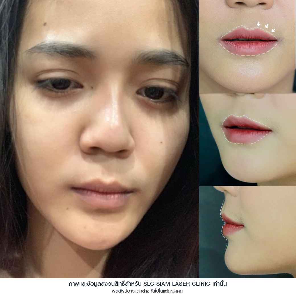 ฉีดปาก_ฟิลเลอร์_Filler Lip_ลำไย ไหทองคำ_ฉีดสารเติมเต็ม_ฉีดขมับ_ฉีดร่องแก้ม