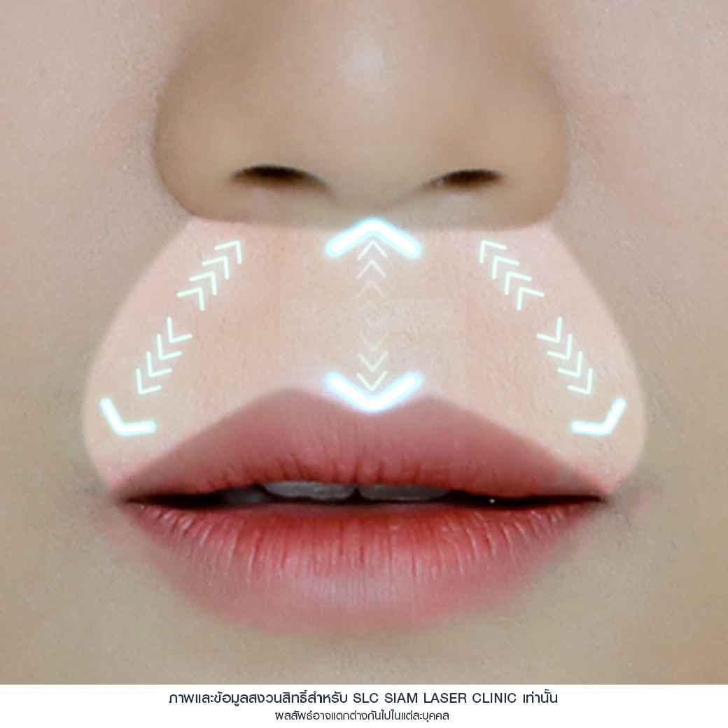 ฉีดปาก_ฟิลเลอร์_Filler Lip_ลำไย ไหทองคำ_ฉีดสารเติมเต็ม_ฉีดขมับ_ฉีดร่องแก้ม