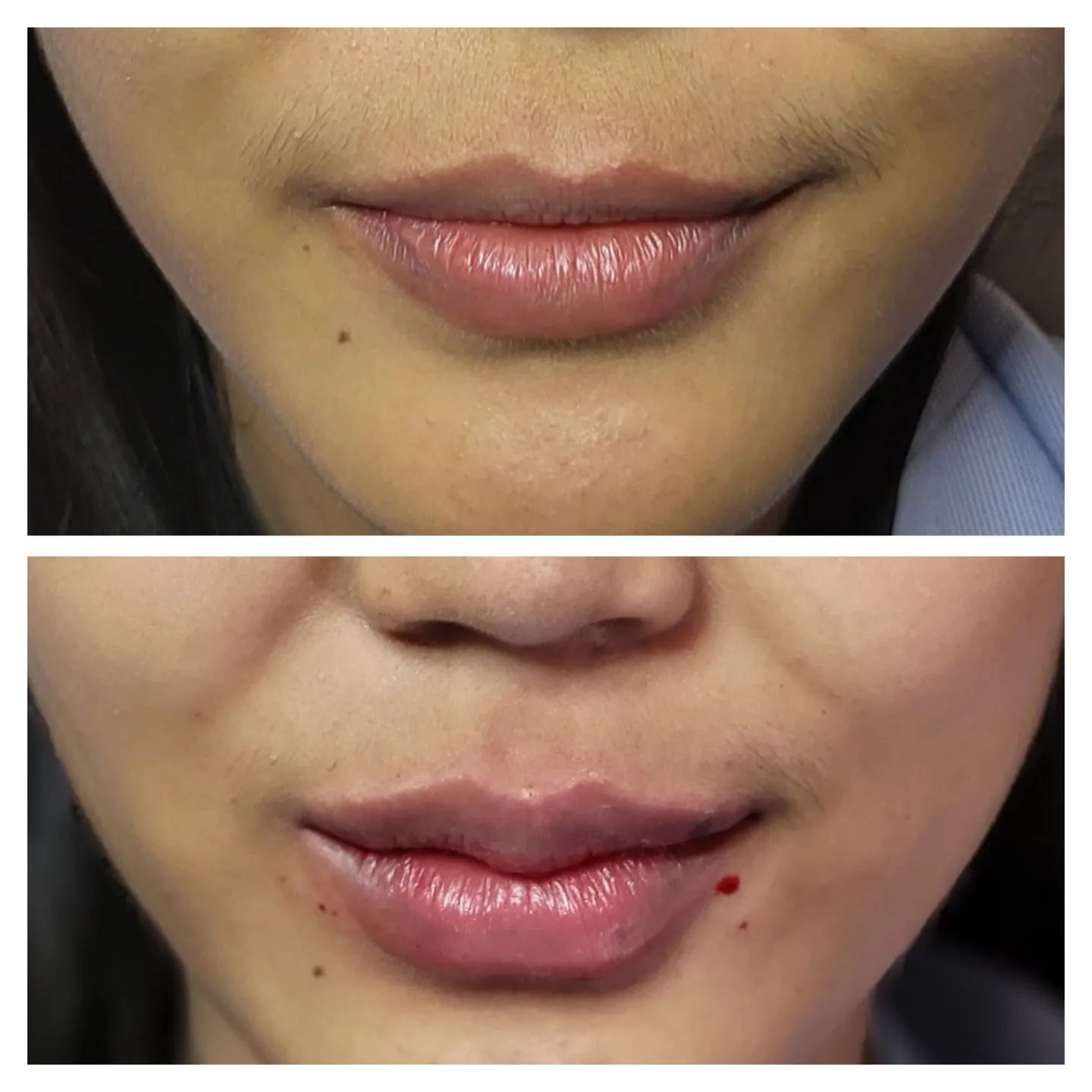 ฉีดปาก_ฟิลเลอร์_Filler Lip_ลำไย ไหทองคำ_ฉีดสารเติมเต็ม_ฉีดขมับ_ฉีดร่องแก้ม