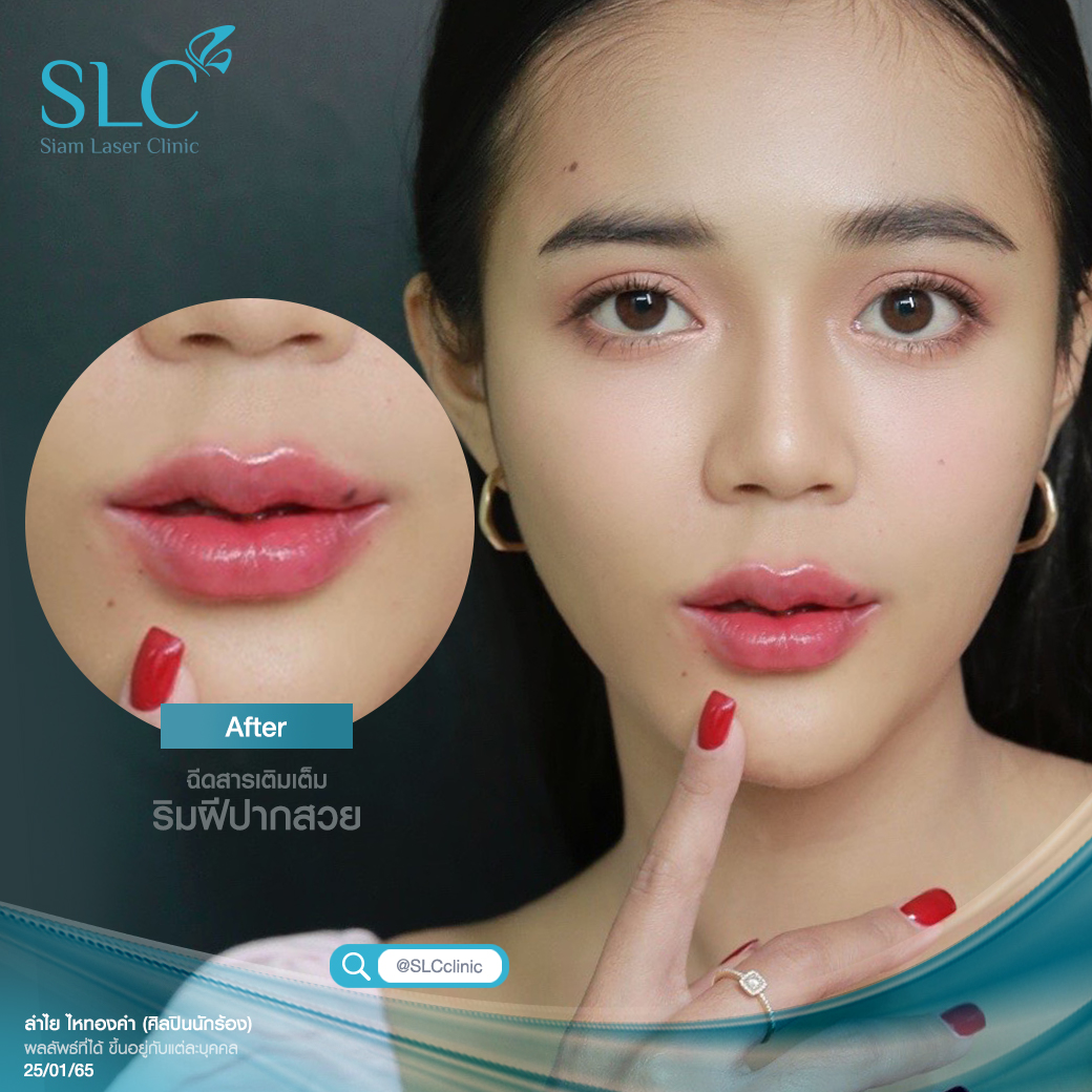 ฉีดปาก_ฟิลเลอร์_Filler Lip_ลำไย ไหทองคำ_ฉีดสารเติมเต็ม_ฉีดขมับ_ฉีดร่องแก้ม