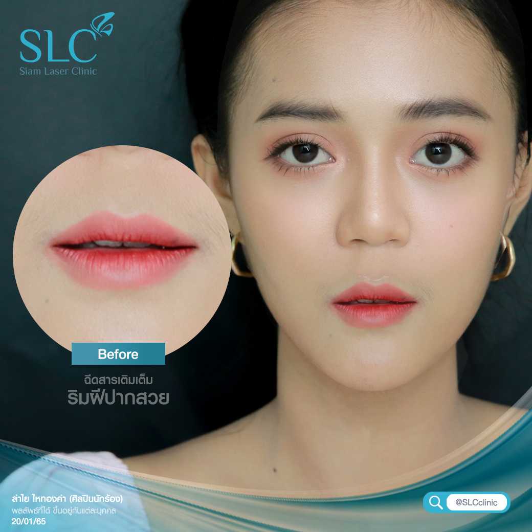 ฉีดปาก_ฟิลเลอร์_Filler Lip_ลำไย ไหทองคำ_ฉีดสารเติมเต็ม_ฉีดขมับ_ฉีดร่องแก้ม