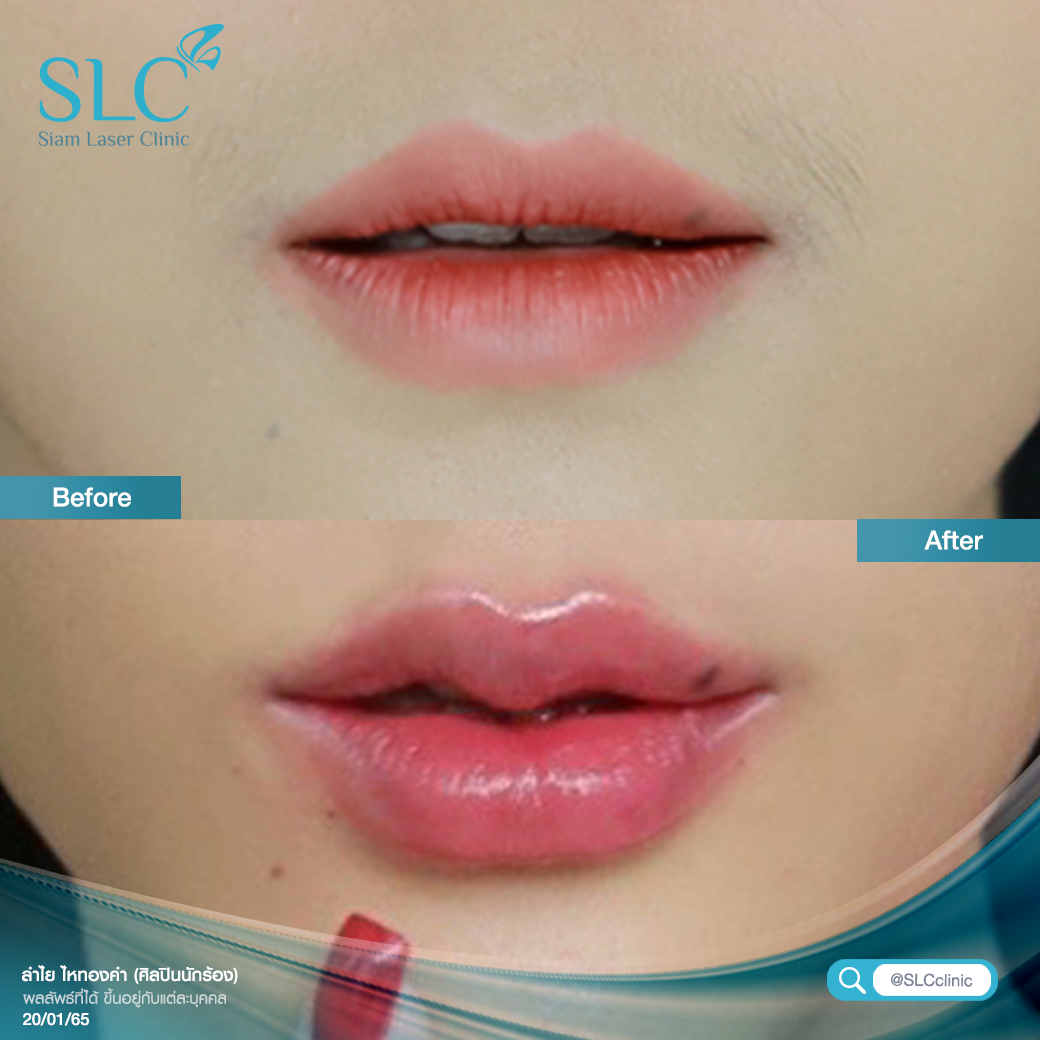 ฉีดปาก_ฟิลเลอร์_Filler Lip_ลำไย ไหทองคำ_ฉีดสารเติมเต็ม_ฉีดขมับ_ฉีดร่องแก้ม