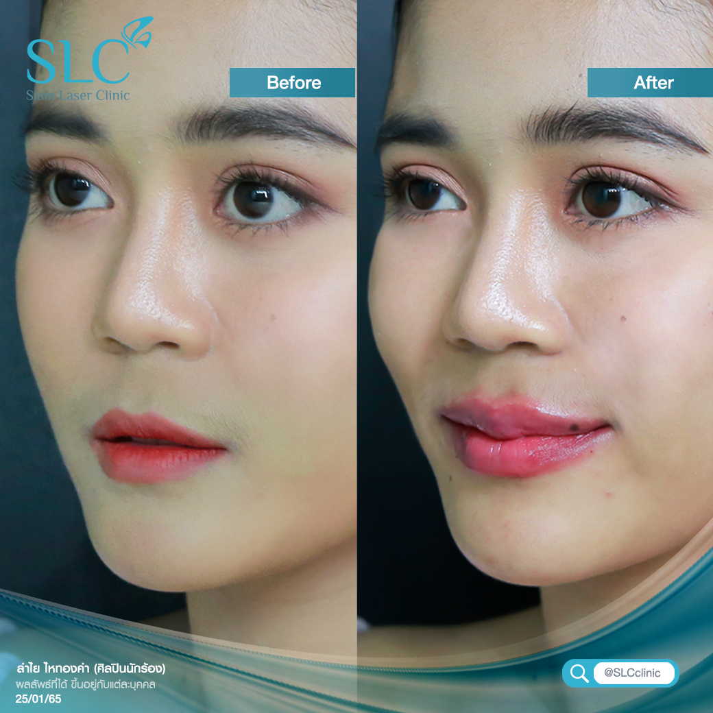 ฉีดปาก_ฟิลเลอร์_Filler Lip_ลำไย ไหทองคำ_ฉีดสารเติมเต็ม_ฉีดขมับ_ฉีดร่องแก้ม