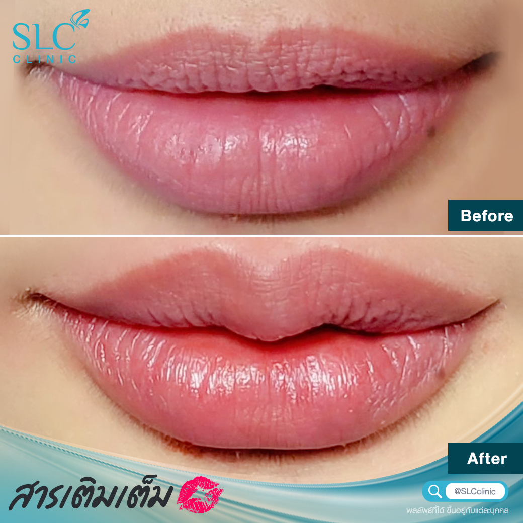 Filler_lip filler_Filler injection_lip injection