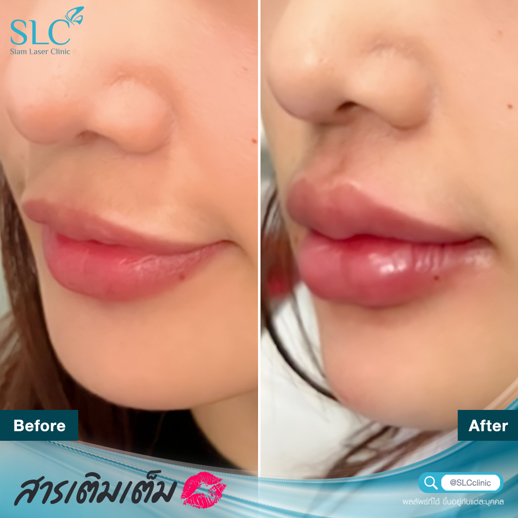 Filler_lip filler_Filler injection_lip injection