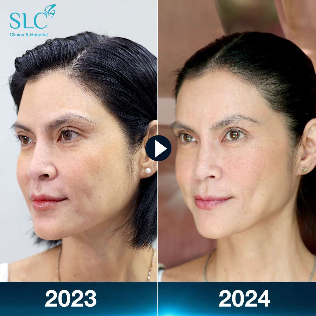 ปิ่น เก็จมณี,Slyfirm X,Sculptra,Emface,Meso Nano,Pora Cool,Pico Plus Laser,Radiesse,Treatment,ปิ่น,แม่ปิ่น,SLC clinic