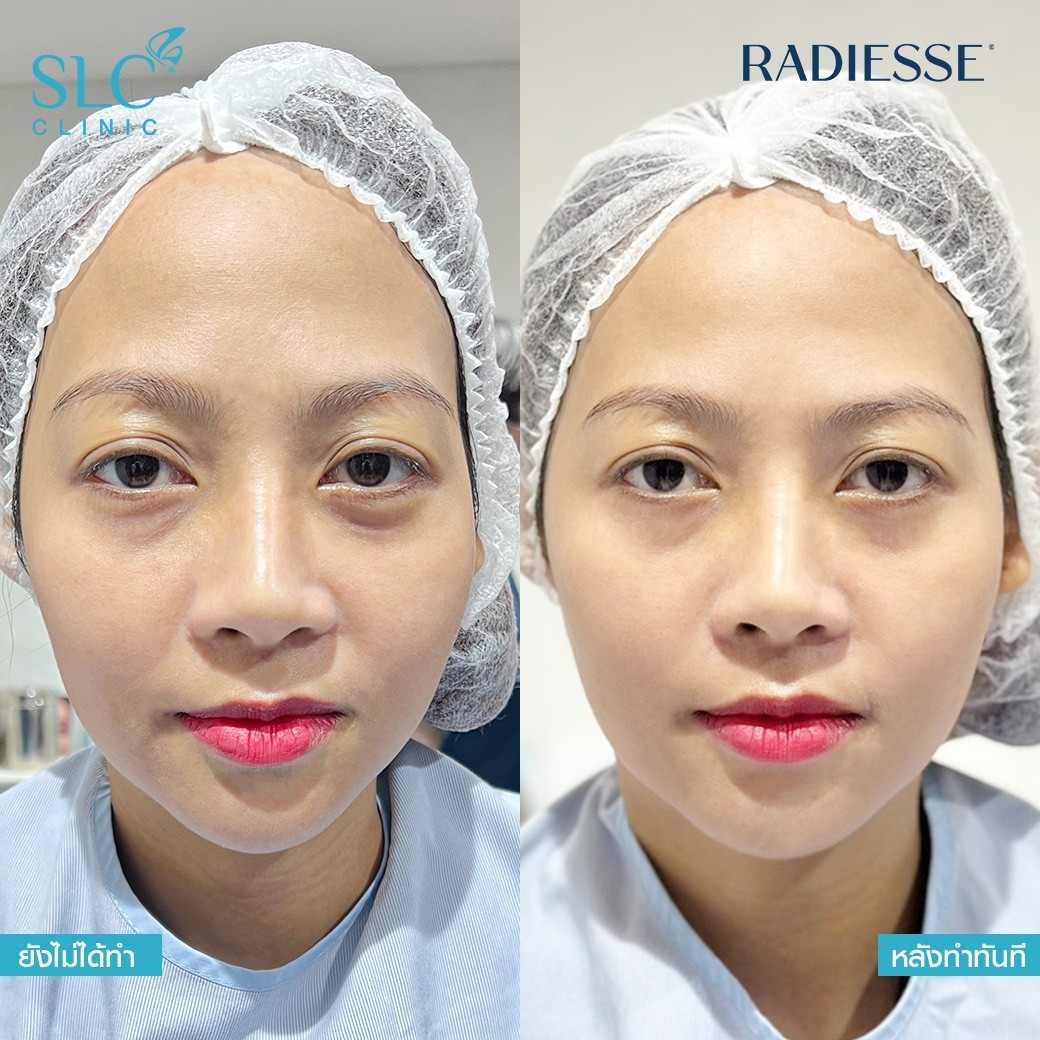 ปิ่น เก็จมณี,Radiesse,Treatment,ปิ่น,แม่ปิ่น,SLC clinic