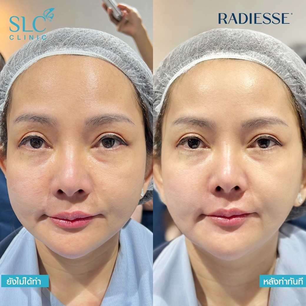 ปิ่น เก็จมณี,Radiesse,Treatment,ปิ่น,แม่ปิ่น,SLC clinic