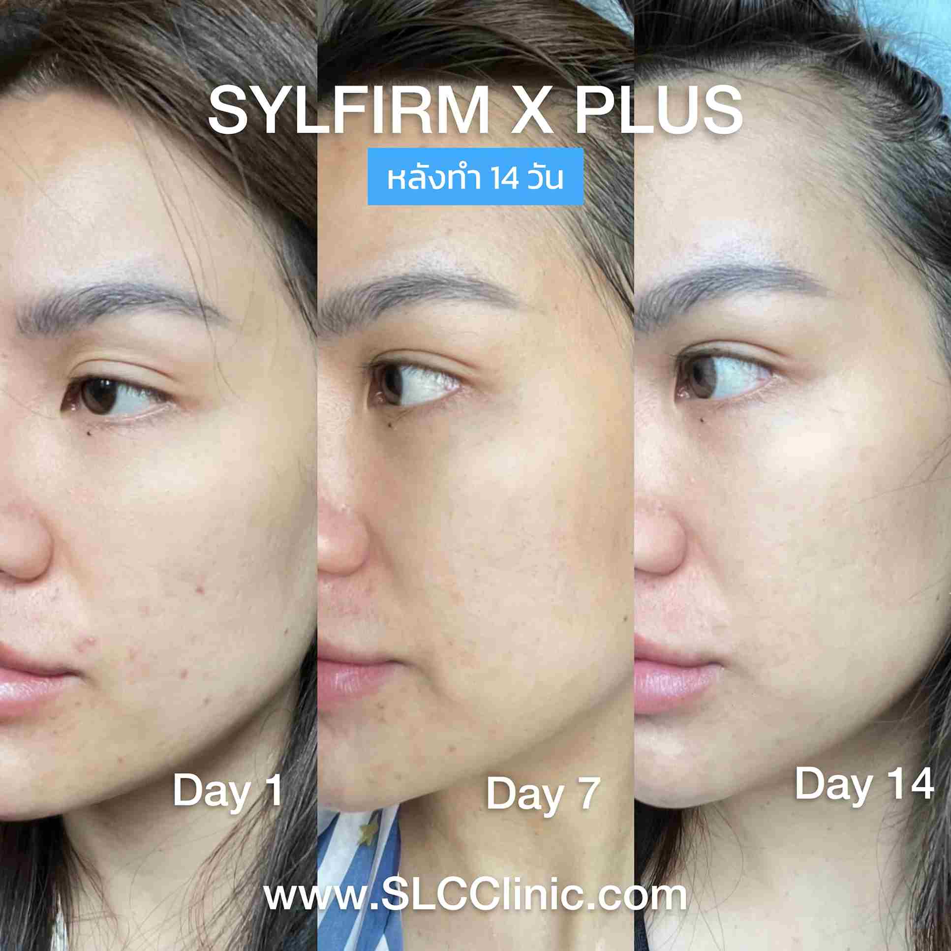 ปิ่น เก็จมณี,Slyfirm X,Pico Plus Laser,ปิ่น,แม่ปิ่น,SLC clinic