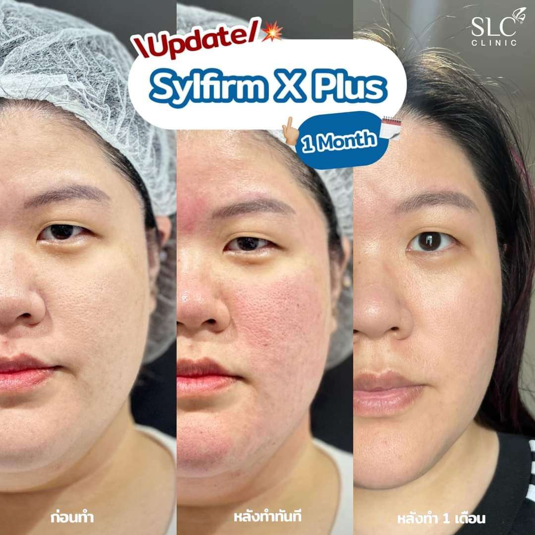 ปิ่น เก็จมณี,Slyfirm X,Pico Plus Laser,ปิ่น,แม่ปิ่น,SLC clinic