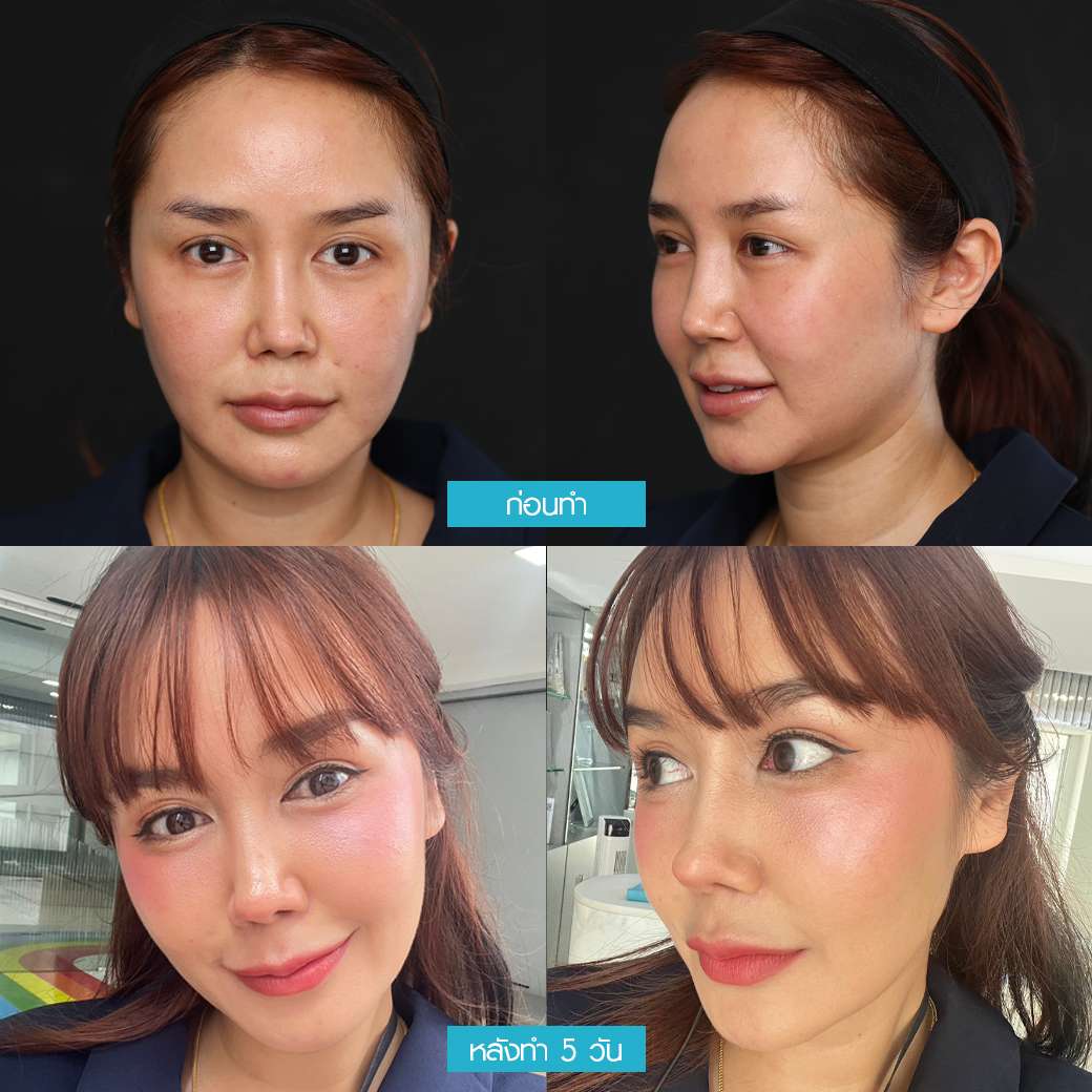 ปิ่น เก็จมณี,Sculptra,ปิ่น,แม่ปิ่น,SLC clinic