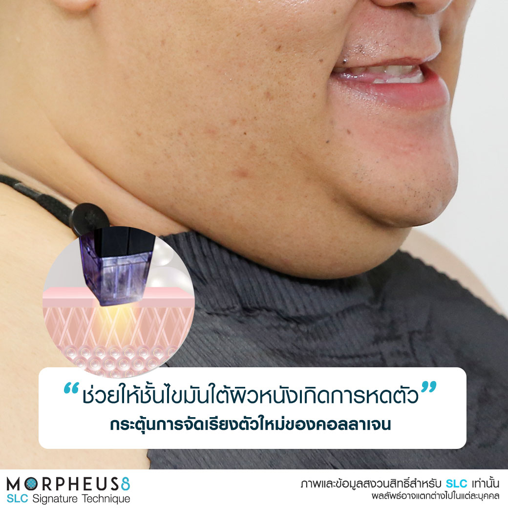 กู้ผิวยับ, ยกกระชับผิว, Morpheus 8,รักแร้ดำทำไงดี , ปิงปองทำรักแร้ที่ไหน , แก้รักแร้หนังไก่ 