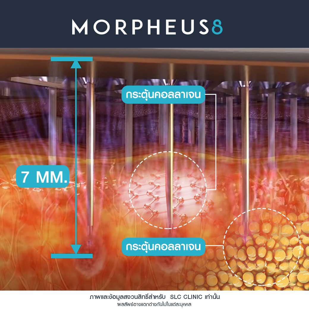 กู้ผิวยับ, ยกกระชับผิว, Morpheus 8,รักแร้ดำทำไงดี , ปิงปองทำรักแร้ที่ไหน , แก้รักแร้หนังไก่ 