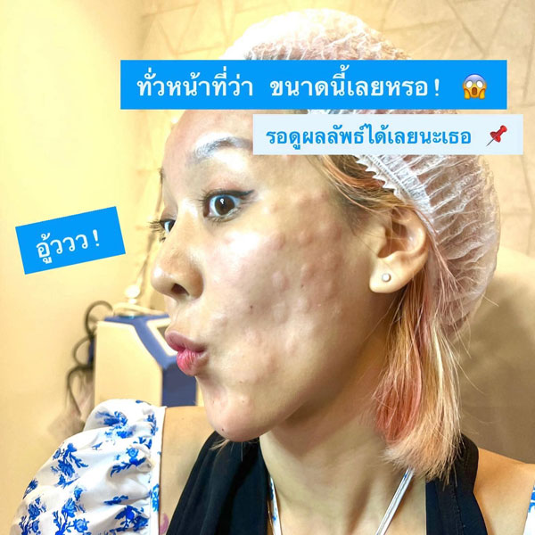  รีวิวGlow Codeกู้หน้าใส-GlowcodeSLC-ทรีทเมนท์หน้าใส