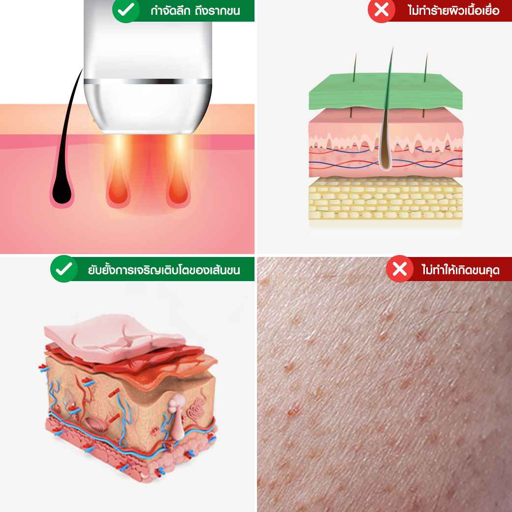 ข้อดีของการทำ Laser Hair Removal 