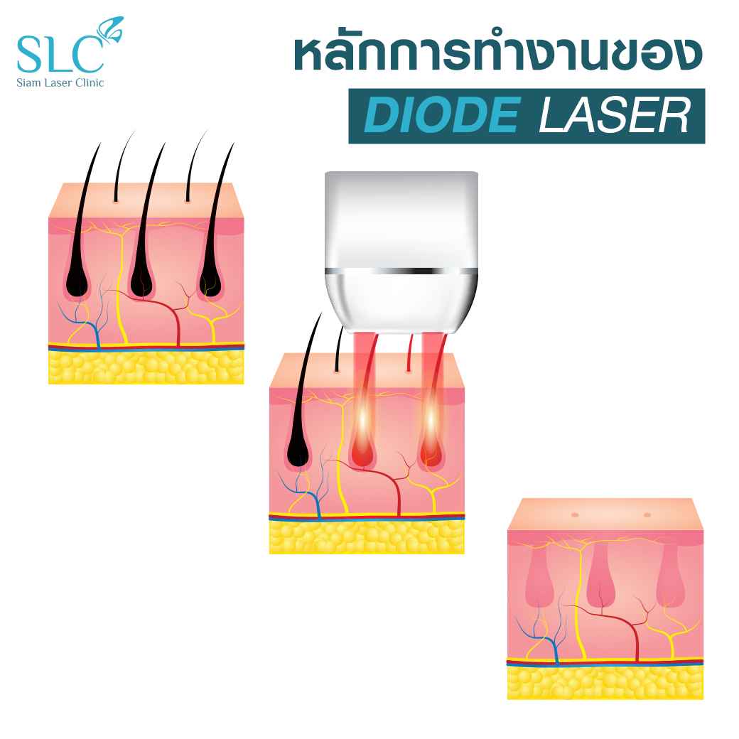 diode laser