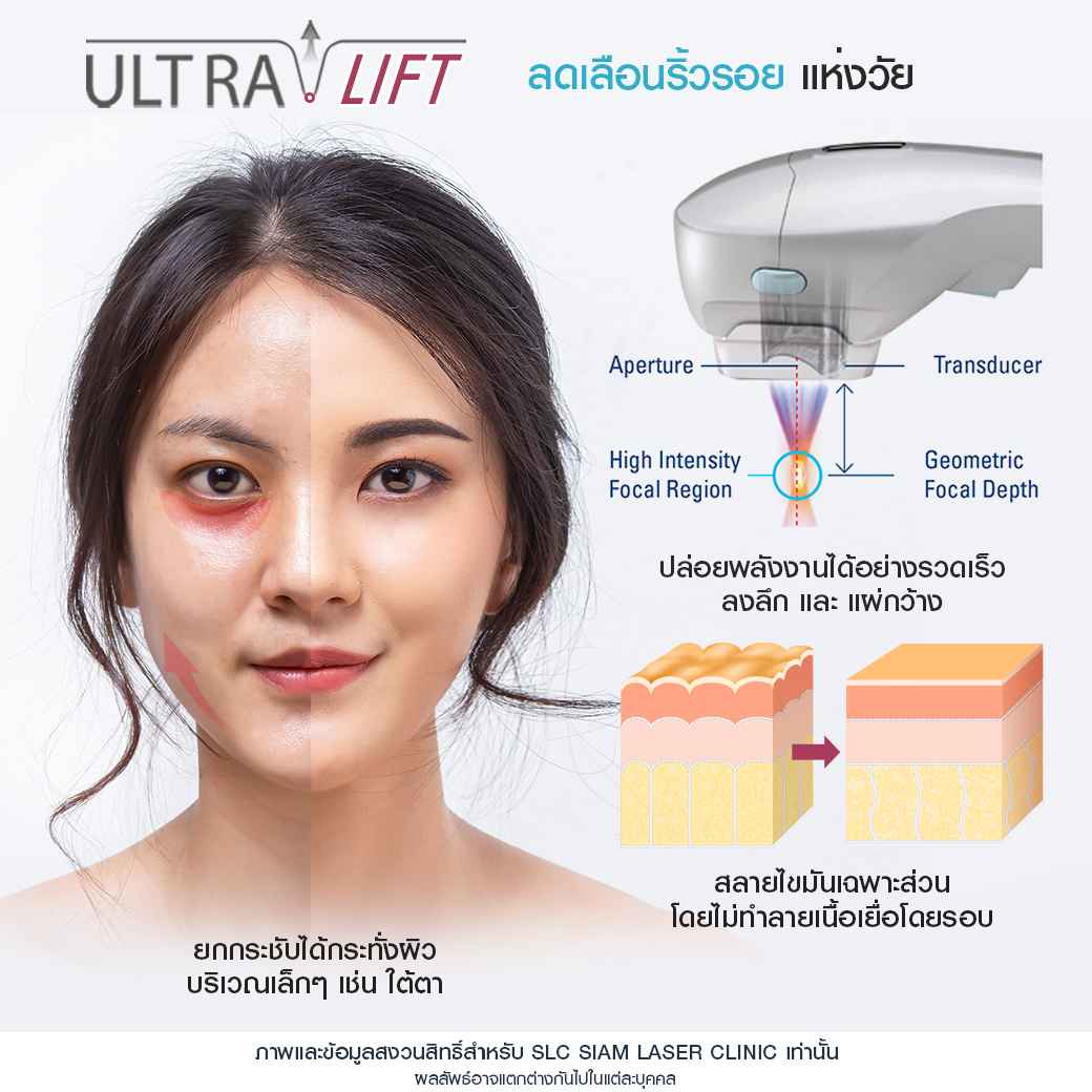 ยกกระชับ-ยกคิ้ว-ยกหน้า-รวมรีวิวยกกระชับ-รีวิวยกกระชับ-ultralift