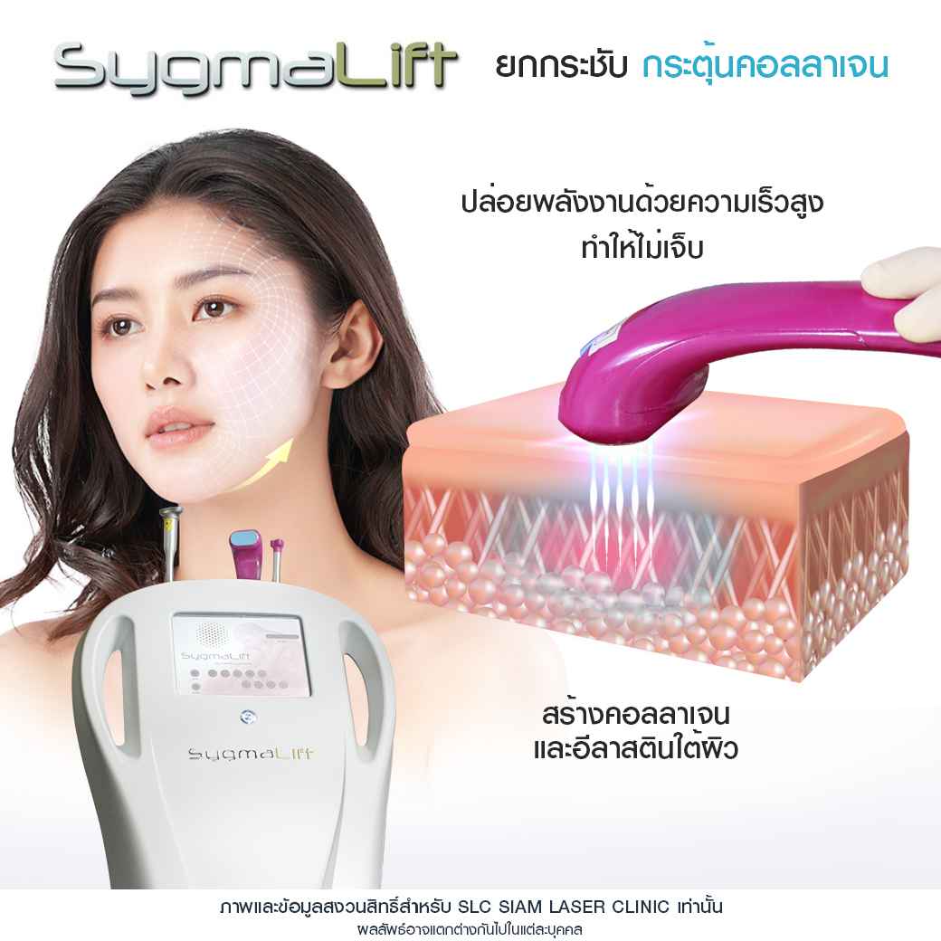 ยกกระชับ-ยกคิ้ว-ยกหน้า-รวมรีวิวยกกระชับ-รีวิวยกกระชับ-sygmalift-hifu