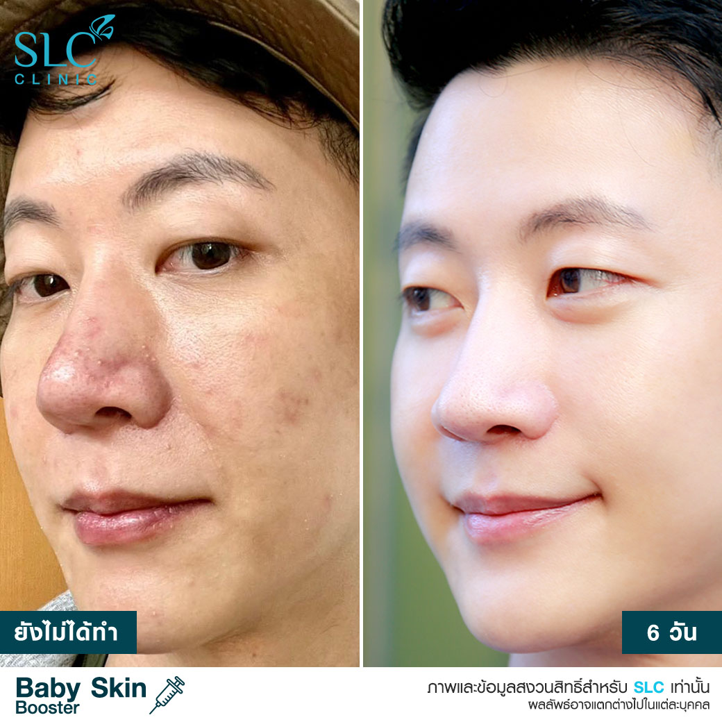  หน้าเด็ก , ผิวเด็ก , ผิวแพ้ง่าย , วิตามินบูสต์ผิวเด็ก , เอ็กโซโซม , Baby Skin Booster™  Link Brief AW : 