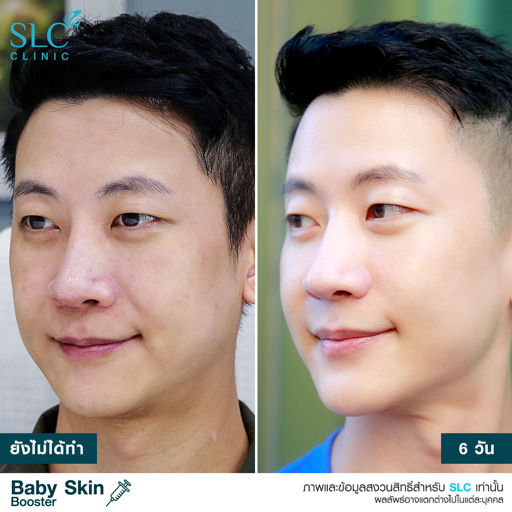  หน้าเด็ก , ผิวเด็ก , ผิวแพ้ง่าย , วิตามินบูสต์ผิวเด็ก , เอ็กโซโซม , Baby Skin Booster™  Link Brief AW : 