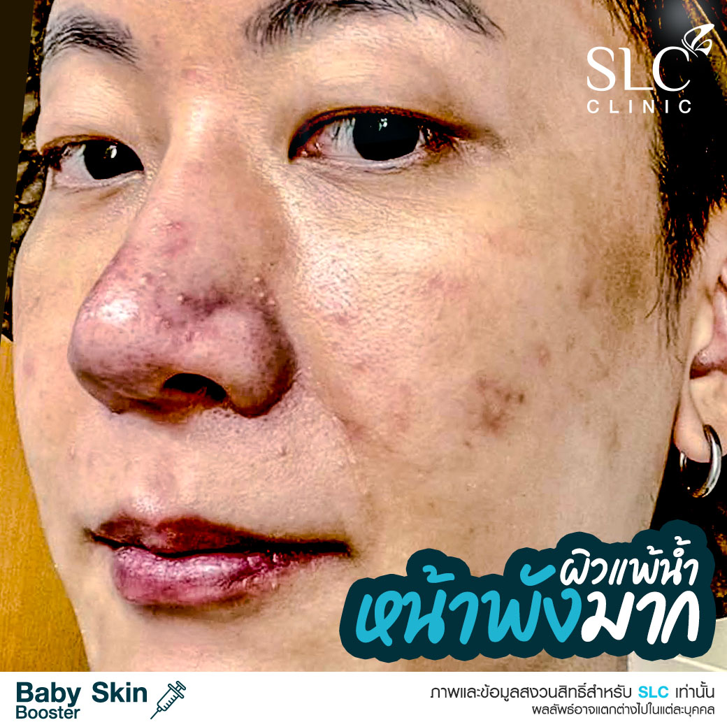  หน้าเด็ก , ผิวเด็ก , ผิวแพ้ง่าย , วิตามินบูสต์ผิวเด็ก , เอ็กโซโซม , Baby Skin Booster™ 