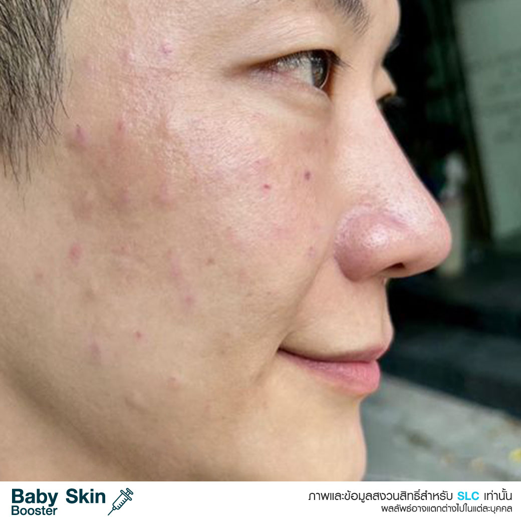  หน้าเด็ก , ผิวเด็ก , ผิวแพ้ง่าย , วิตามินบูสต์ผิวเด็ก , เอ็กโซโซม , Baby Skin Booster™  Link Brief AW : 