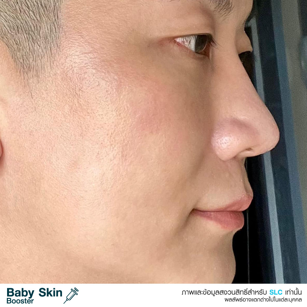  หน้าเด็ก , ผิวเด็ก , ผิวแพ้ง่าย , วิตามินบูสต์ผิวเด็ก , เอ็กโซโซม , Baby Skin Booster™  Link Brief AW : 