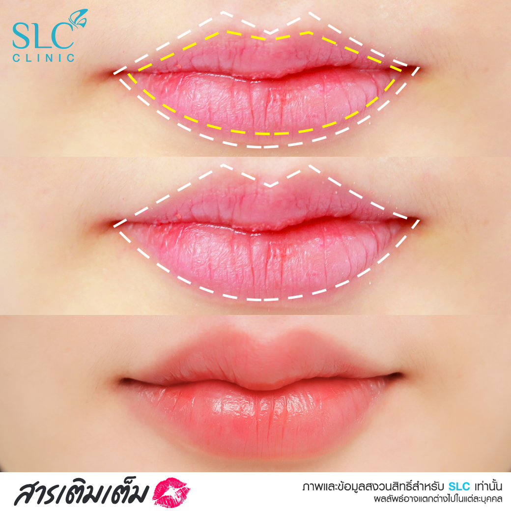 ฟิลเลอร์ปาก ฉีดปาก Filler Lip  เติมปาก ปากสวยๆ ปากสวยเกาหลี คุณหมอดา SLC 