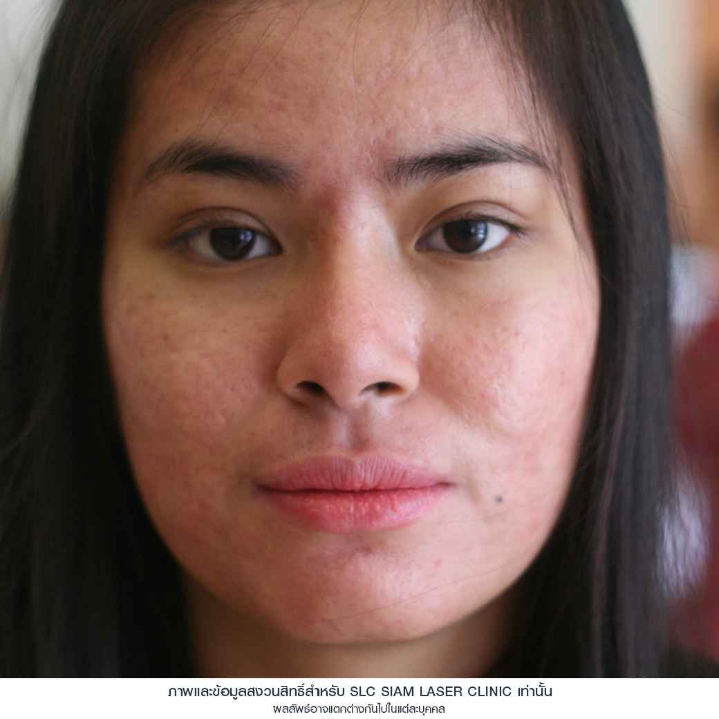 Fraxel Restore Laser_E Matrix ETWO_ acne scars_damaged skin_acne invasion