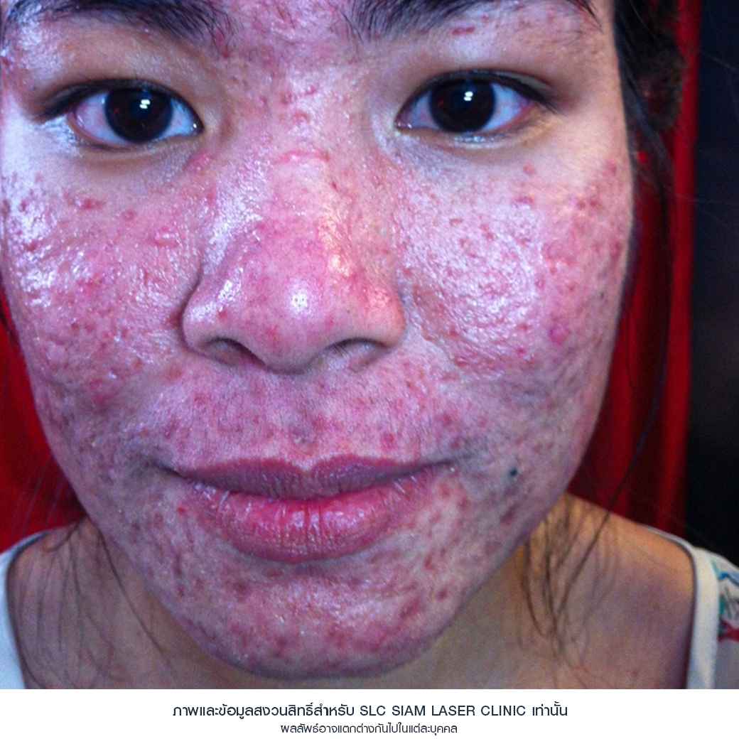 Fraxel Restore Laser_E Matrix ETWO_ acne scars_damaged skin_acne invasion