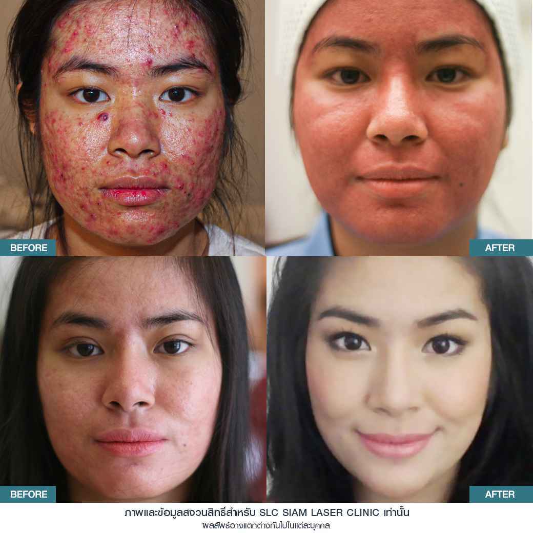 Fraxel Restore Laser_E Matrix ETWO_ acne scars_damaged skin_acne invasion
