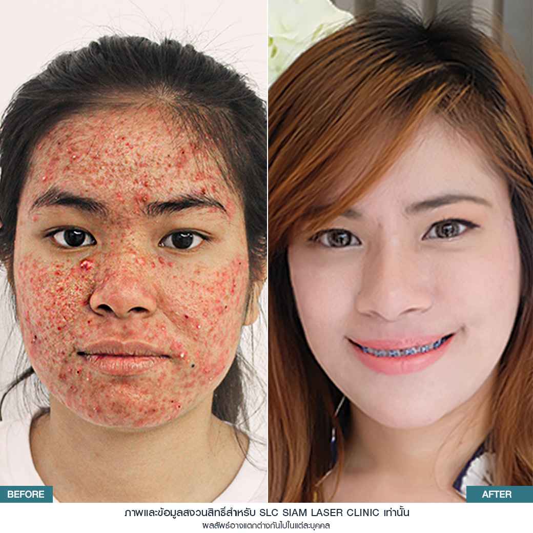 Fraxel Restore Laser_E Matrix ETWO_ acne scars_damaged skin_acne invasion