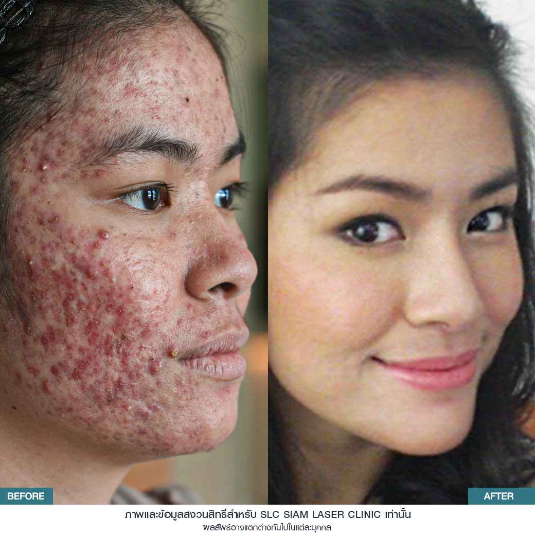 Fraxel Restore Laser_E Matrix ETWO_ acne scars_damaged skin_acne invasion