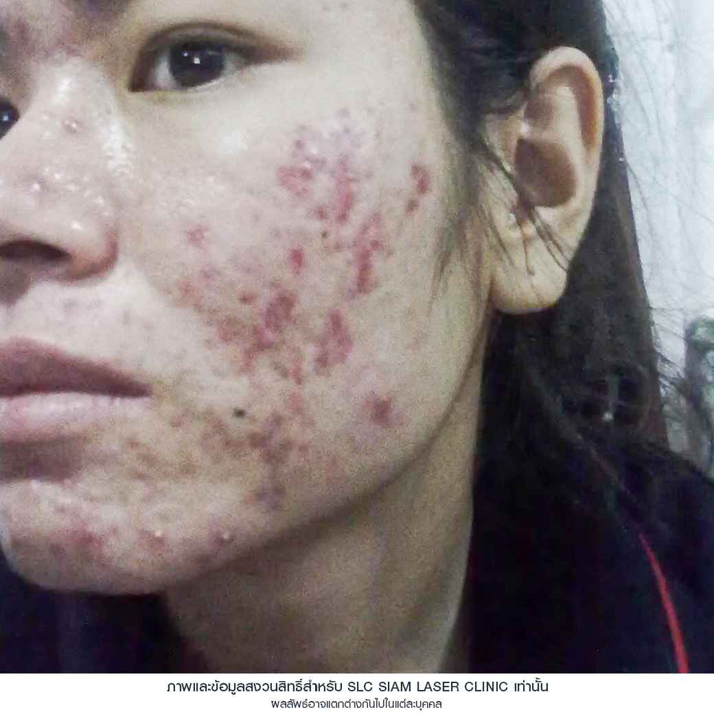 Fraxel Restore Laser_E Matrix ETWO_ acne scars_damaged skin_acne invasion