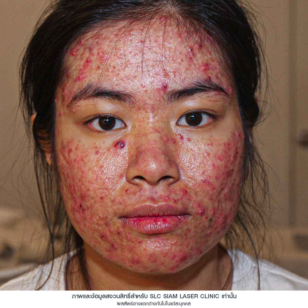 Fraxel Restore Laser_E Matrix ETWO_ acne scars_damaged skin_acne invasion