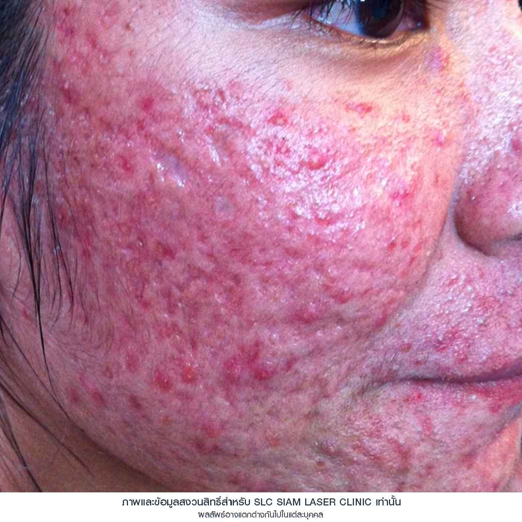 Fraxel Restore Laser_E Matrix ETWO_ acne scars_damaged skin_acne invasion