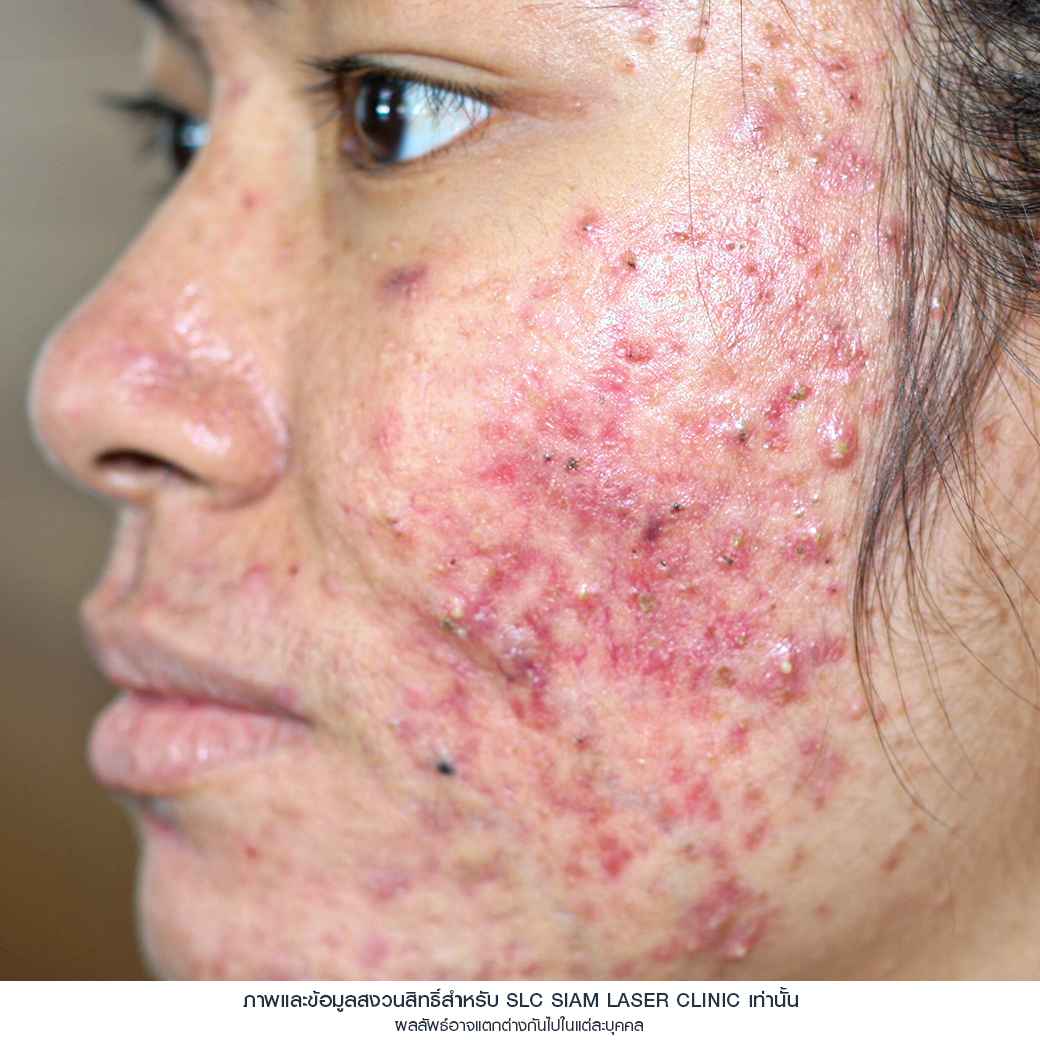 Fraxel Restore Laser_E Matrix ETWO_ acne scars_damaged skin_acne invasion