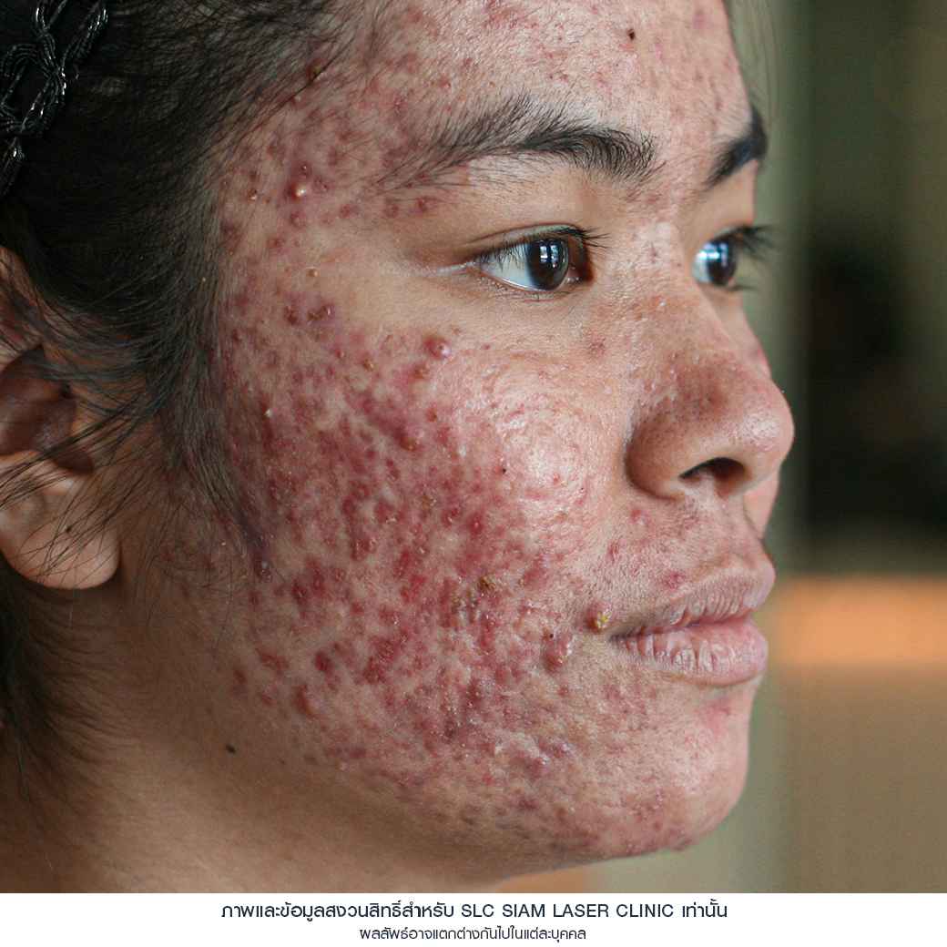 Fraxel Restore Laser_E Matrix ETWO_ acne scars_damaged skin_acne invasion