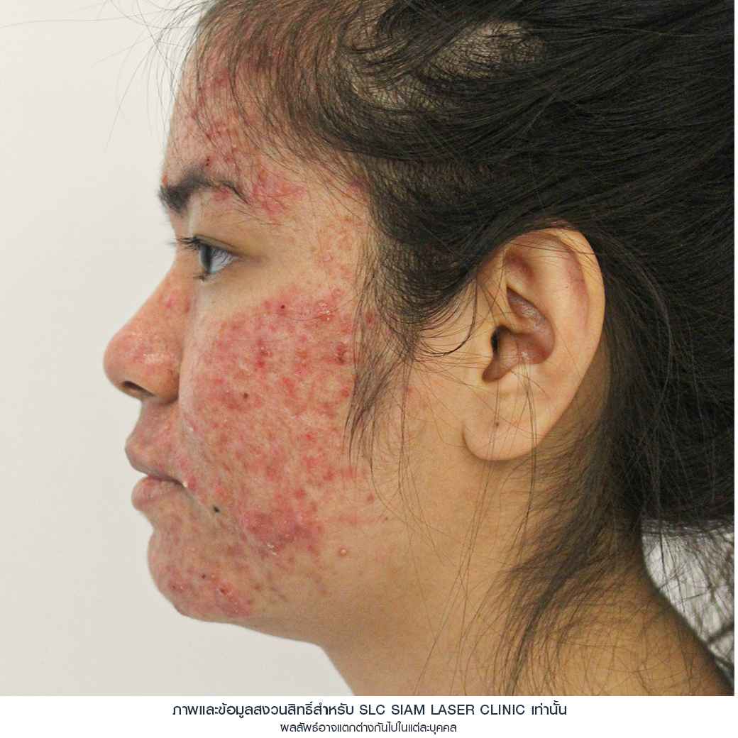 Fraxel Restore Laser_E Matrix ETWO_ acne scars_damaged skin_acne invasion