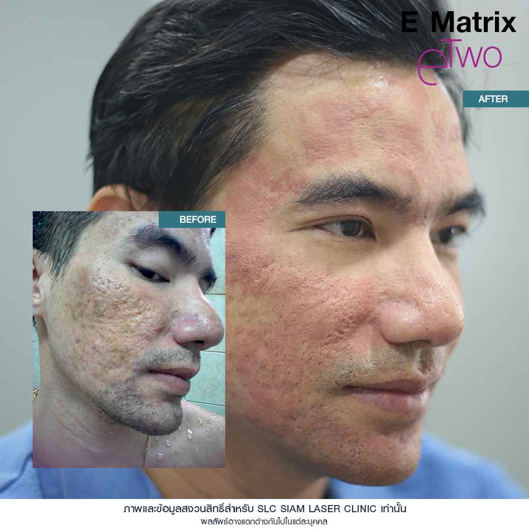 Fraxel Restore Laser_E Matrix ETWO_ acne scars_damaged skin_acne invasion