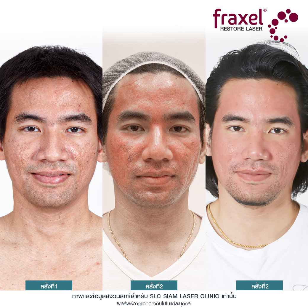 สิว_รอยหลุมสิว_รักษาสิว_Fraxel_Ematrix_เลเซอร์สิว