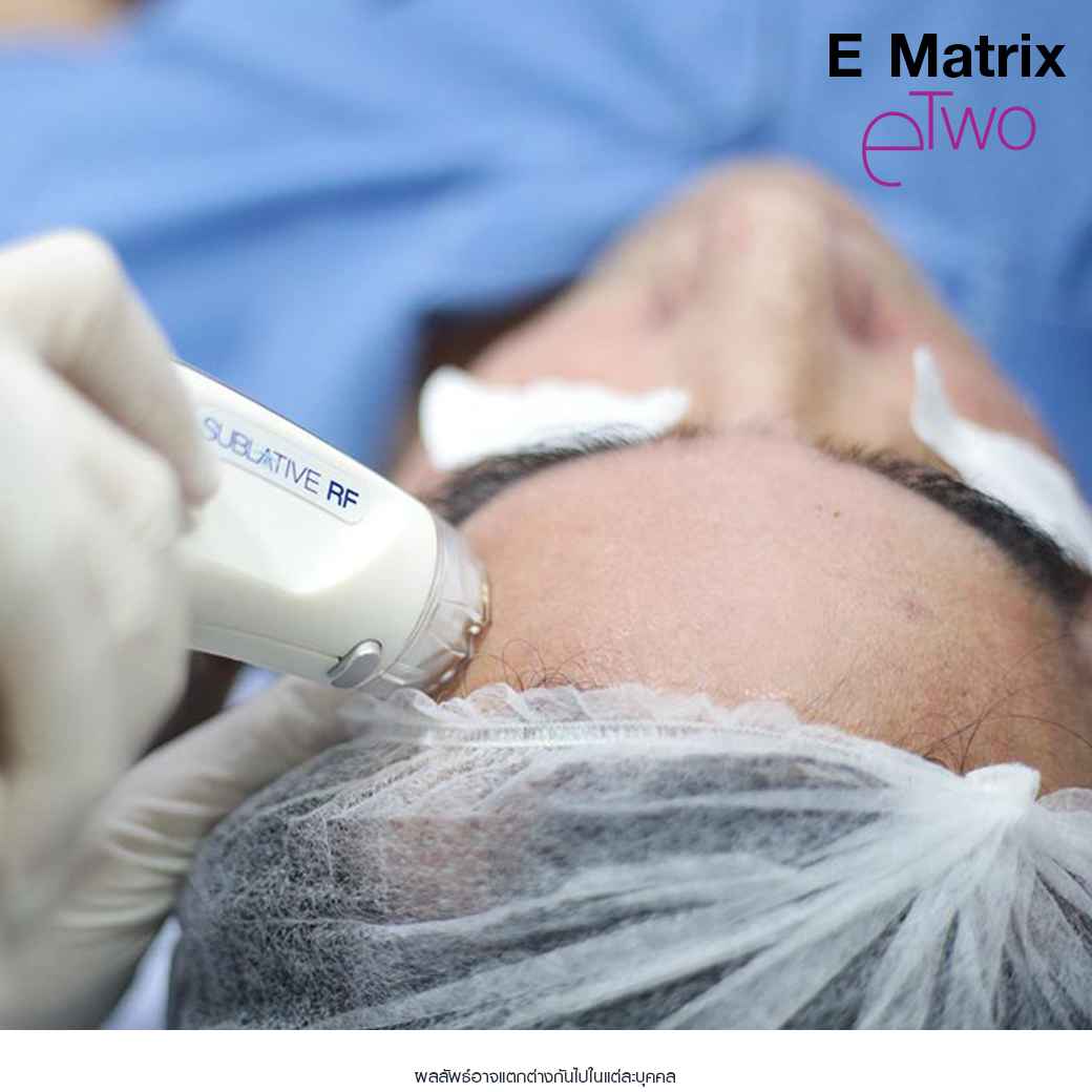 Fraxel Restore Laser_E Matrix ETWO_ acne scars_damaged skin_acne invasion