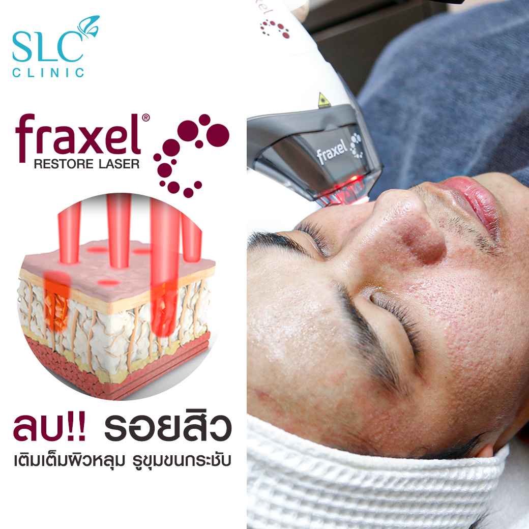 Fraxel Restore Laser_E Matrix ETWO_ acne scars_damaged skin_acne invasion