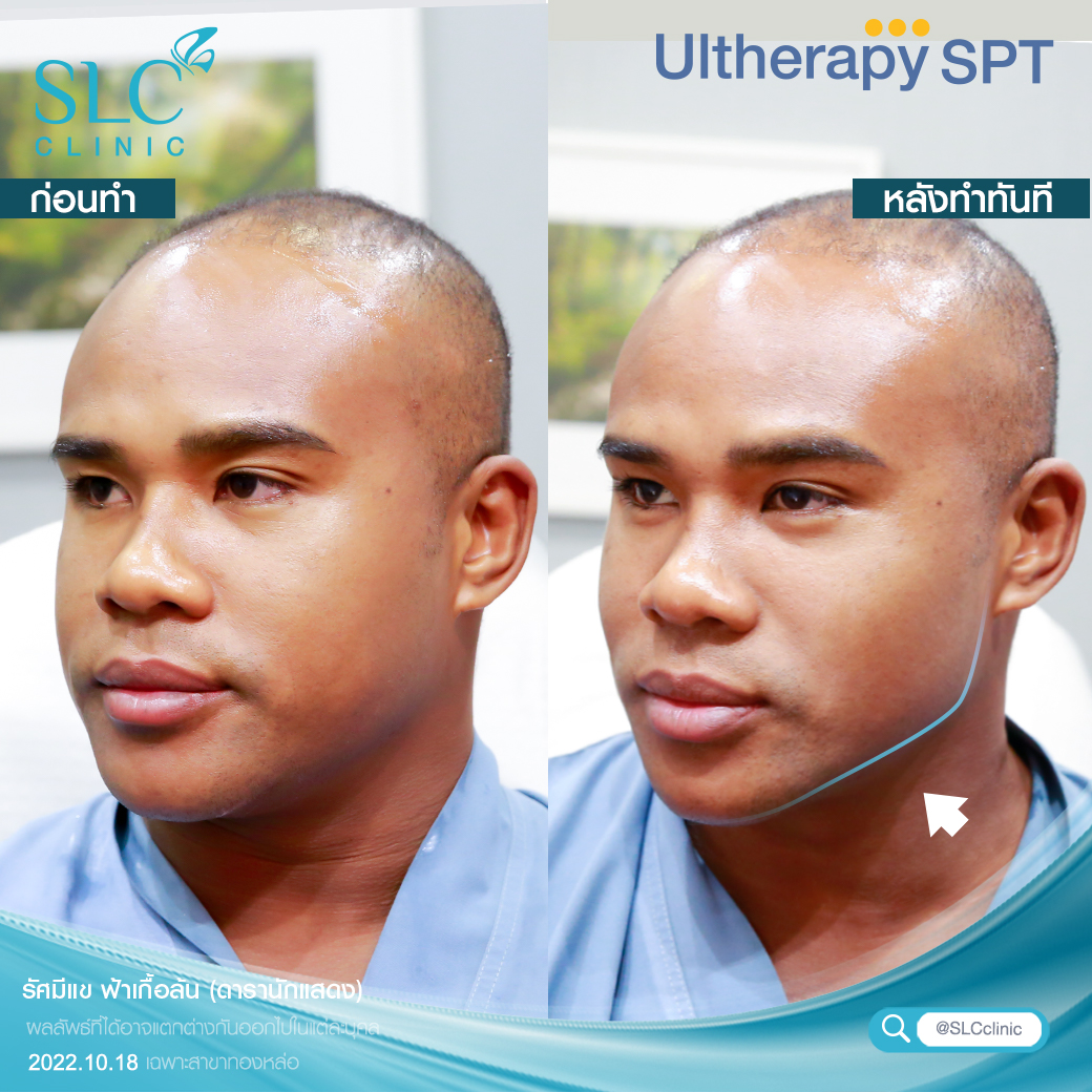 ยกกระชับ Ultherapy SPT ยกผิว ยกหน้า กระชับผิวหน้า ลดริ้วรอย หน้าเรียว ลดเหนียง รีวิวยกกระชับ