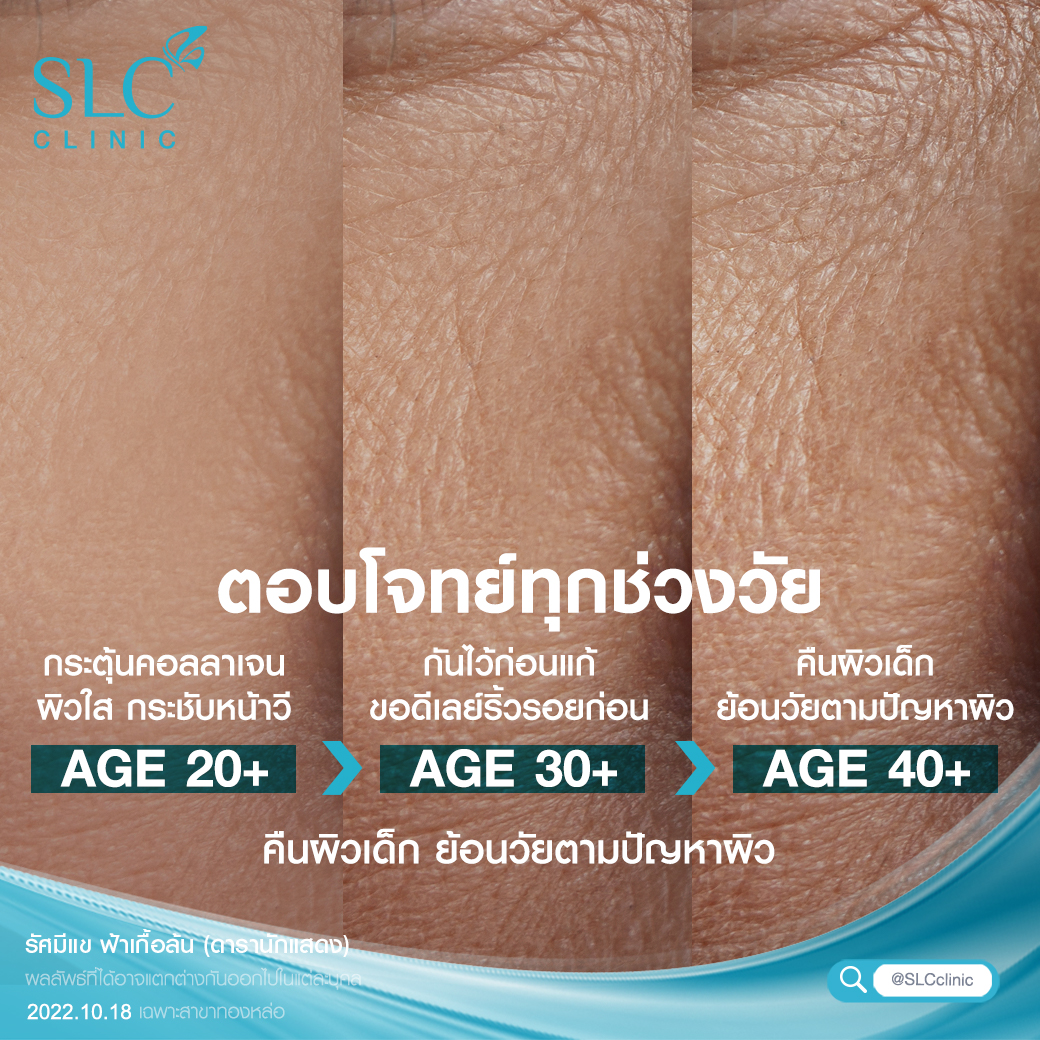 ยกกระชับ Ultherapy SPT ยกผิว ยกหน้า กระชับผิวหน้า ลดริ้วรอย หน้าเรียว ลดเหนียง รีวิวยกกระชับ