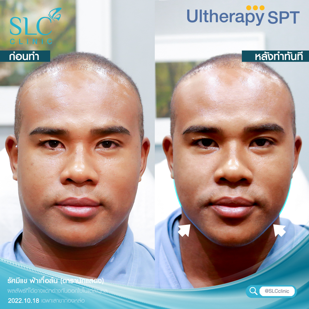 ยกกระชับ Ultherapy SPT ยกผิว ยกหน้า กระชับผิวหน้า ลดริ้วรอย หน้าเรียว ลดเหนียง รีวิวยกกระชับ